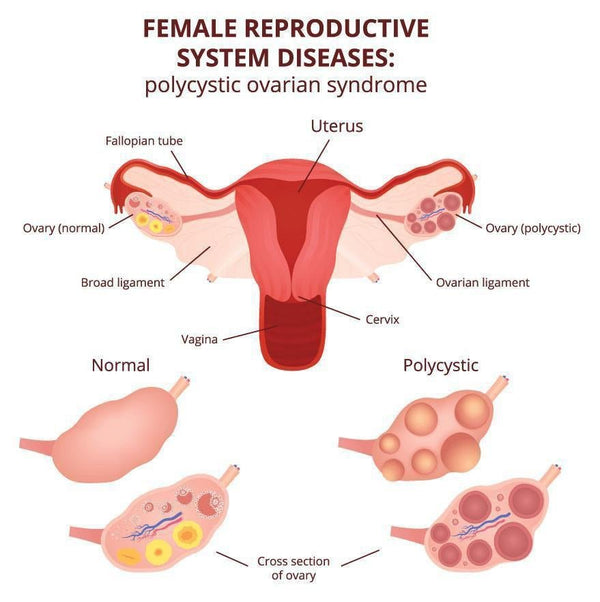 MAJOR CAUSES OF FEMALE INFERTILITY - Supplemena